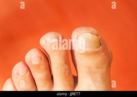 Flies on your fingers. Close up shot of a bad nail finger. Nail care on the foot - pedicure Stock Photo