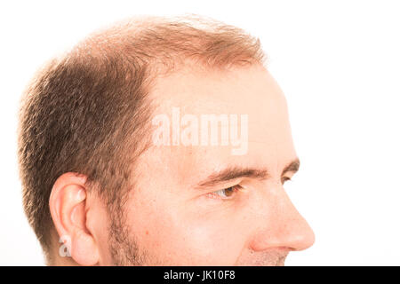 Middle-aged man concerned by hair loss bald baldness alopecia black and white Stock Photo