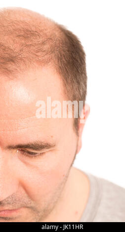 Middle-aged man concerned by hair loss bald baldness alopecia black and white Stock Photo