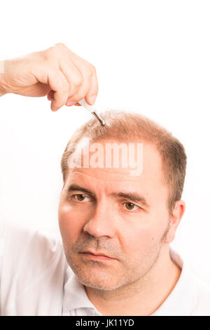 Middle-aged man concerned by hair loss bald baldness alopecia black and white Stock Photo