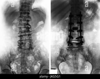 Spondylosis and Scoliosis ( film x-ray lumbar - sacrum spine show ...