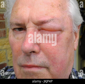 The image shows an allergic reaction to a wasp, bee, hornet, insect sting.  The reaction to a venomous sting can range from mild to fatal.  This image does NOT require a model release as the subject is the photographer. The sting was from a so-called social wasp - the photographer considers that the action was not very sociable ! Stock Photo