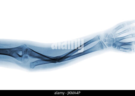 Film x-ray forearm AP show fracture shaft of ulnar bone . Stock Photo