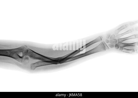 Film x-ray forearm AP show fracture shaft of ulnar bone . Stock Photo