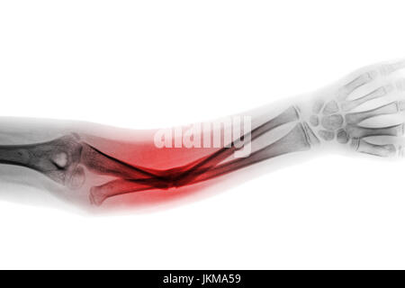 Film x-ray forearm AP show fracture shaft of ulnar bone . Stock Photo