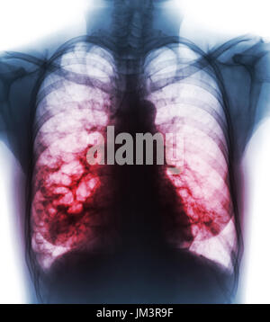 Bronchiectasis .  X-ray chest show multiple lung bleb and cyst due to chronic infection . Front view . Stock Photo