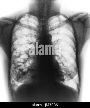 Bronchiectasis .  X-ray chest show multiple lung bleb and cyst due to chronic infection . Front view . Stock Photo