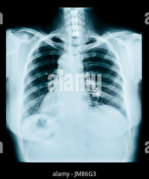 Human Thoracci Radiograph Human thorax x-ray for lungs examination, PA up right. Cancer infected ...