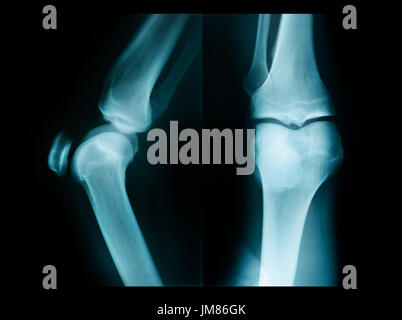 X-ray of the knee joints, a picture of the bones of the knee on the x ...