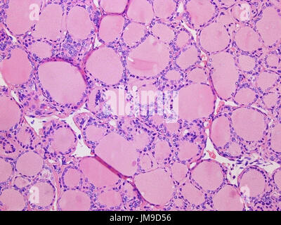 Thyroid Gland Colloid Viewed at 200x Magnification with Haemotoxylin and Eosin Staining. Stock Photo