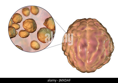 Meningitis caused by the fungus Cryptococcus, computer illustration. Cryptococcus neoformans is the common cause of meningitis in HIV-infected patients. The illustration shows swelling of meninges and close-up view of C. neoformans. Stock Photo