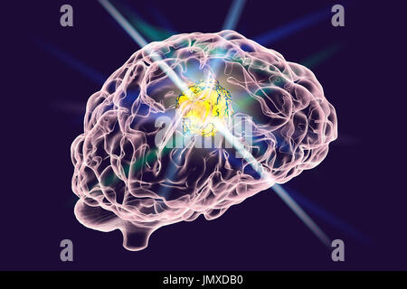 Conceptual image for brain cancer treatment. Computer illustration showing destruction of brain tumour. Stock Photo