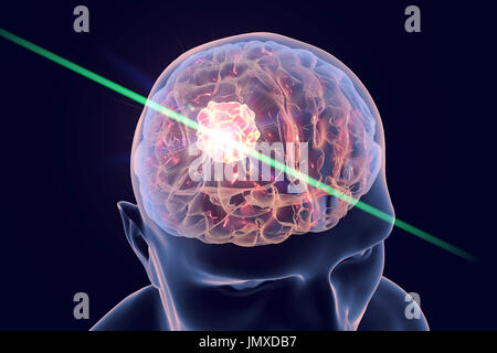 Conceptual image for use of laserotherapy for brain cancer treatment. Computer illustration showing destruction of brain tumour by laser. Stock Photo