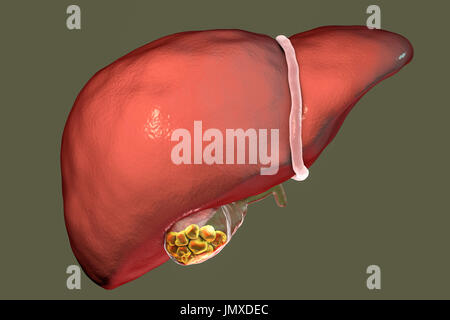 Gallstones. Illustration showing the liver and gallbladder with gallstones. The gallbladder stores bile, the digestive fluid that is produced by the liver (above gallbladder) and passed to the small intestine. Gallstones, hard deposits formed of cholesterol and bile salts, form in the gallbladder when there is an imbalance in the chemical composition of the bile. Gallstones are usually symptomless, unless one obstructs the bile duct, causing acute pain, jaundice and infection. Treatment is with drugs to dissolve the stones or surgical removal of the gallbladder. Stock Photo