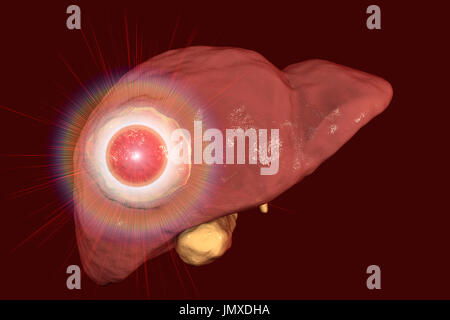 Liver cancer treatment, conceptual image. Stock Photo