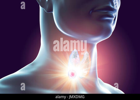 Destruction of thyroid tumour, computer illustration. Conceptual image for thyroid nodules and cancer treatment. Stock Photo
