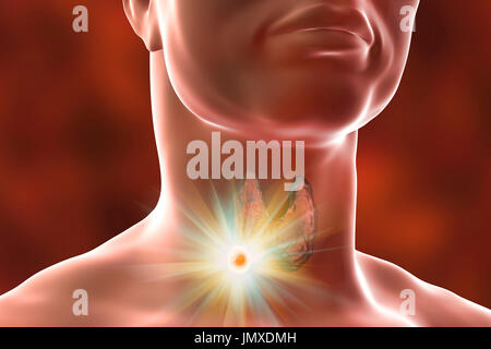 Destruction of thyroid tumour, computer illustration. Conceptual image for thyroid nodules and cancer treatment. Stock Photo