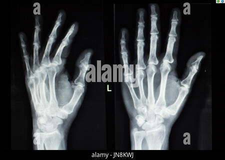 Arthritic hand. X-ray of the hand of a patient with severe rheumatoid ...