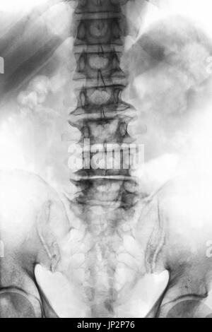 Spondylosis .  film x-ray lumbosacral spine of old aged patient show osteophyte , collapse spine from degenerative process . Front view . Stock Photo