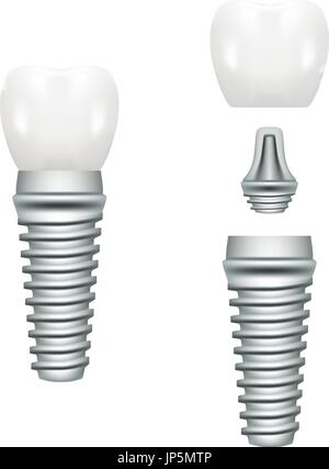 Realistic Dental Implant Structure With All Parts Crown, Abutment, Screw Isolated On A White Background. Vector Illustration. Stock Vector