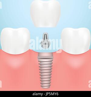 Tooth Human Implant. Dental Concept. Human Teeth Or Dentures Isolated On A Background. Vector Illustration. Stock Vector