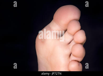 Painful corn (clavus or callus) on foot of young woman under toe, isolated on black background Stock Photo