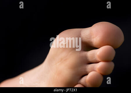 Painful corn (clavus or callus) on foot of young woman under toe, isolated on black background Stock Photo