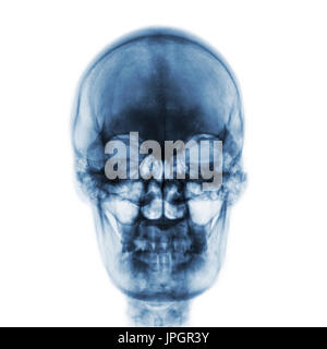 Film x-ray of normal human skull on isolated background . Front view . Stock Photo