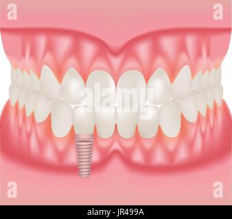 Human Jaw Model With Teeth And Implant. Installation Of Dental Implants Isolated On A White Background. Vector Illustration. Stock Vector