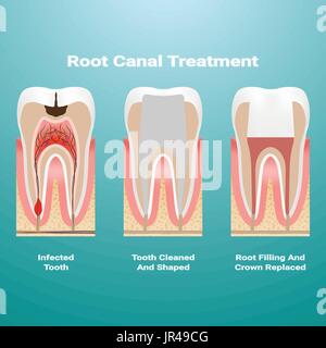 Pulpitis. Root Canal Therapy. Infected Pulp Is Removed From The Tooth And The Space Occupied By It Is Cleaned And Filled With A Gutta Percha Isolated On A Background. Vector Illustration. Stock Vector