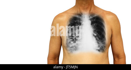 Bronchiectasis .  Human chest with x-ray chest show multiple lung bleb and cyst due to chronic infection . Isolated background . Blank area at Left si Stock Photo