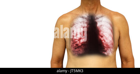 Bronchiectasis .  Human chest with x-ray chest show multiple lung bleb and cyst due to chronic infection . Isolated background . Blank area at Left si Stock Photo