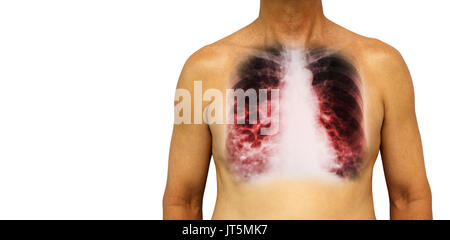 Bronchiectasis .  Human chest with x-ray chest show multiple lung bleb and cyst due to chronic infection . Isolated background . Blank area at Left si Stock Photo