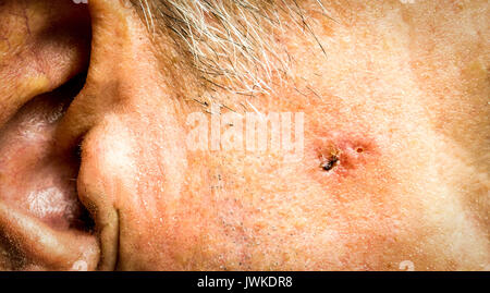 Basal Cell Carcinoma on the face of older man before surgery - closeup Stock Photo