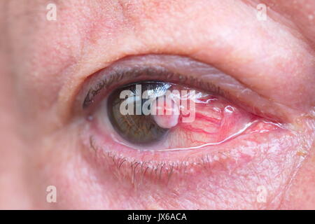 Close up of the eye conjunctiva squamous cell carcinoma Stock Photo