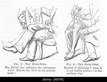 'Knee Jerk' from W R Gowers' Manual of Diseases of the Nervous System 1886 Stock Photo