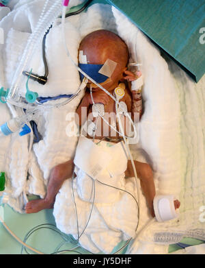 Hanover, Germany. 11th Aug, 2017. A 5-day-old boy who weighed 430 grams at birth, in an incubator at the children's clinic of Hannover Medical School (Medizinische Hochschule Hannover, MHH) in Hanover, Germany, 11 August 2017. Between 500 and 600 children are treated every year at the intensive care unit for premature and newborn babies, of which around 120 are premature babies weighing less than 1,500 grams. Photo: Holger Hollemann/dpa/Alamy Live News Stock Photo