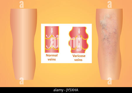 Varicose veins on a female senior leg Stock Photo