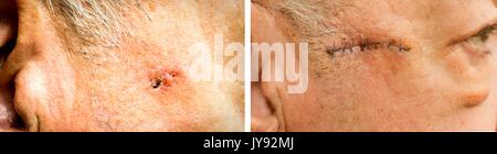 Basal Cell Carcinoma on the face of older man before and after surgery - closeup Stock Photo