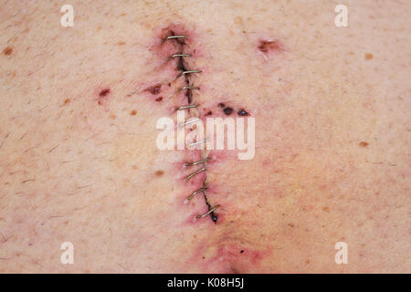 Stitches from a surgery Stock Photo