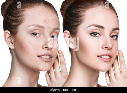 Young woman with acne before and after treatment Stock Photo