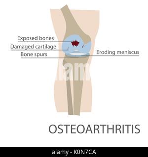 osteoarthritis human knee joint disease. vector format illustration Stock Vector