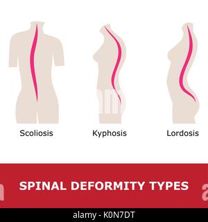 The Position Of The Spine With Lordosis. Spinal Curvature, Kyphosis ...