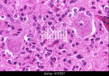 Photomicrograph of HandE stained brain tissue from a rabies ...