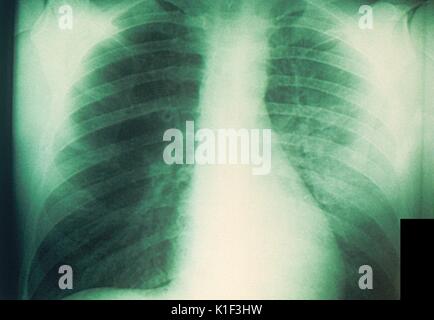 plague 1965 alamy patient yersinia bacteria bubonic caused pestis which anteroposterior chest ray ap