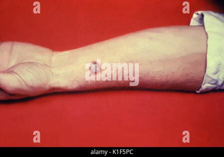 Anthrax, skin of left forearm. Cutaneous anthrax lesion on left forearm of a white male. Image courtesy CDC. 1990. Stock Photo