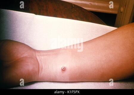 Anthrax, skin of right forearm, 4th day. 27 year old white female with cutaneous anthrax on right forearm, she'd worked in a spinning department of a goat hair processing plant for 3 years, lesion as seen on 4th day. Image courtesy CDC. 1990. Stock Photo