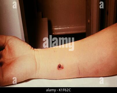 Anthrax, skin of right forearm, 7th day. 27 year old white female with cutaneous anthrax on right forearm, patient had worked in a spinning department of a goat hair processing plant for 3 years, lesion as seen on 7th day. Image courtesy CDC. 1990. Stock Photo