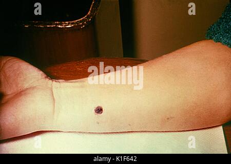 Anthrax, skin of right forearm, 12th day. 27 year old white female with cutaneous anthrax on right forearm, patient had worked in a spinning department of a goat hair processing plant for 3 years, lesion as seen on 12th day. Image courtesy CDC/Arthur E. Kaye, 1972. Stock Photo