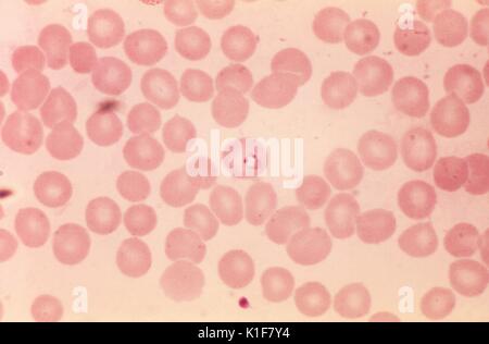 A photomicrograph of a blood smear revealing an erythrocyte containing a Plasmodium vivax parasite, magnified 1000X. Malarial parasites undergo asexual multiplication in the erythrocytes, i.e. erythrocytic schizogony. During the ring stage, this trophozoite, seen here with 2 chromatin dots, will mature into a schizont, which will rupture releasing merozoites. Image courtesy CDC/Dr. Mae Melvin, 1974. Stock Photo